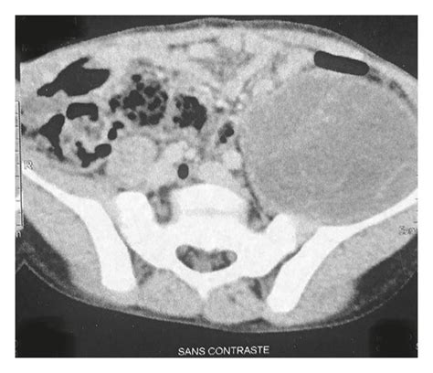 Ct Scan Showing A Well Limited Hydatid Cyst In The Expansion Of Left