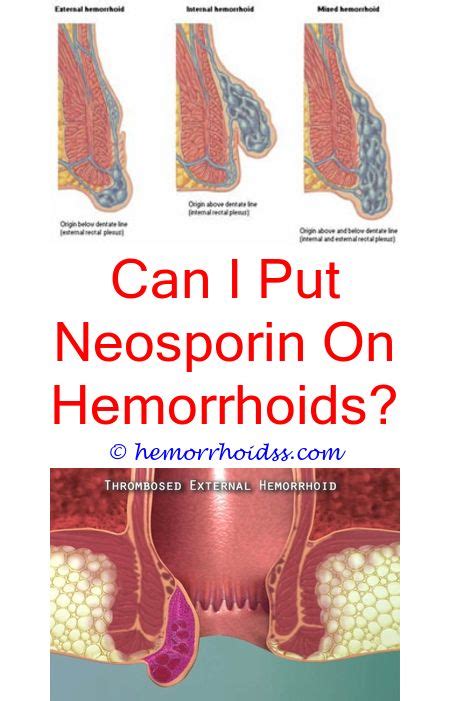 Can You Push A Thrombosed Hemorrhoid Back In How To Get Rid Of