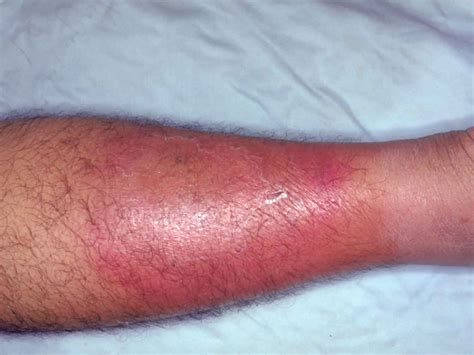 Cellulitis Causes Signs Symptoms Diagnosis Prevention And Treatment