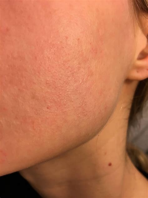 Cystic Acne On Neck And Jawline Babyacnearticles