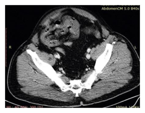 Abdominopelvic Ct Scan With An Intravenous Contrast Agent Topogram A