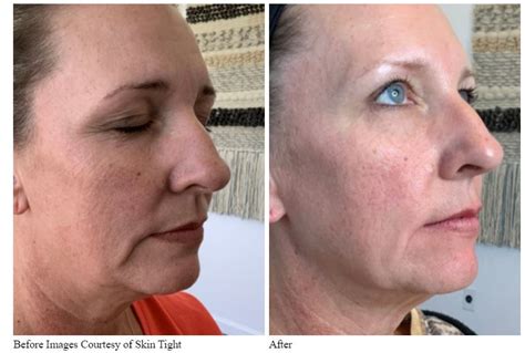 Virtue Radiofrequency Microneedling A Breakthrough In Skin Care