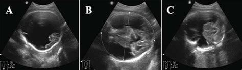 2d Transabdominal Ultrasound Of Fetal Head Axial View At 37 Weeks