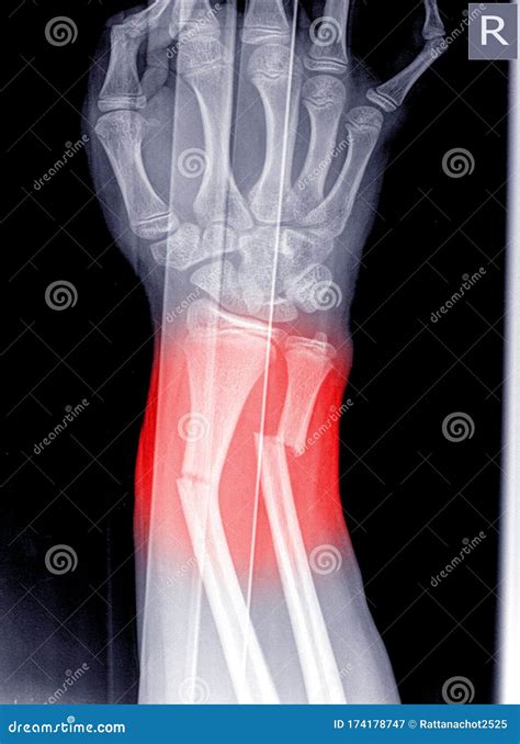 X Ray Image Of Wrist Joint Shows Fracture Of The Distal Radius And