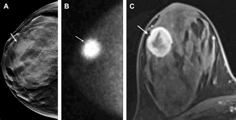 Comparison Of Breast Mr Imaging With Molecular Breast Imaging In Breast Cancer Screening