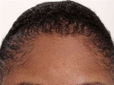 Maybe you would like to learn more about one of these? black female hair transplant - Female Before And After ...