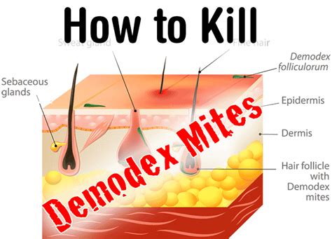How To Kill Demodex Mites Remedies And Natural Remedies