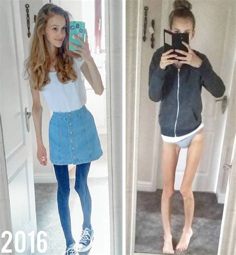 Anorexic Teen Was Rushed To Emergencybecame Fitness Guru After Making