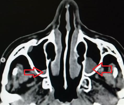 DICAS DE RADIOLOGIA Tudo Sobre Radiologia RAIO X SEIOS DA FACE OU TOMOGRAFIA DA FACE PARA