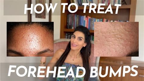 How To Treat Tiny Little Bumps On The Forehead Youtube