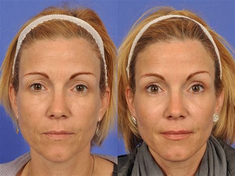 Face lift, neck lift, brow lift, chin liposuction botox- before and after-1 - MISBIW ⎮ Medical Innovative ...