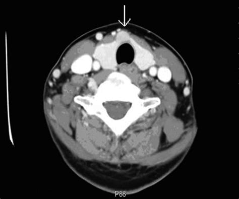 The Neck Ct Showed 1 Cm Sized Non Specific Nodule In The Right Thyroid