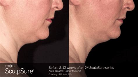 Sculpsure Before And After Nashville Tn