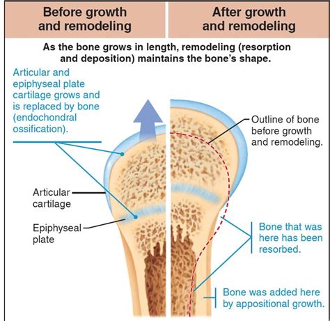Illustration Shows Bone Remodeling During Youth As Appositional Growth