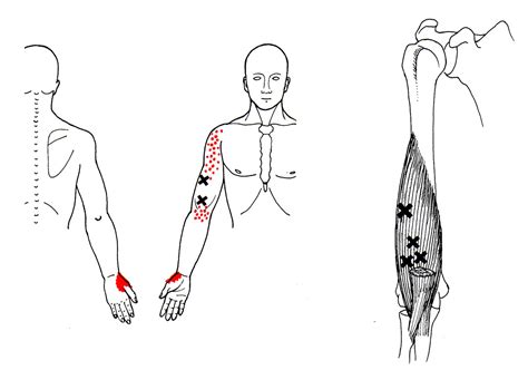 Brachialis The Trigger Point And Referred Pain Guide
