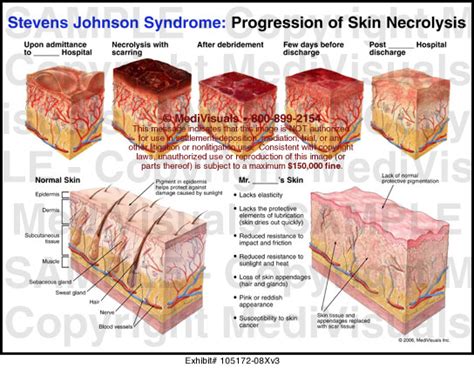 Stevens Johnson Syndrome Progression Of Skin Necrolysis Medical Exhibit