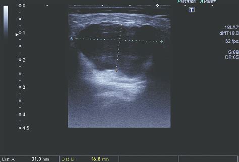 Ultrasonography Demonstrated An Irregular Hypoechoic Solid Mass With