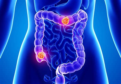 Strictly, cats do not get hemorrhoids, a condition humans get which can look similar to an incomplete prolapse. Colorectal cancer mortality rates increasing in younger ...