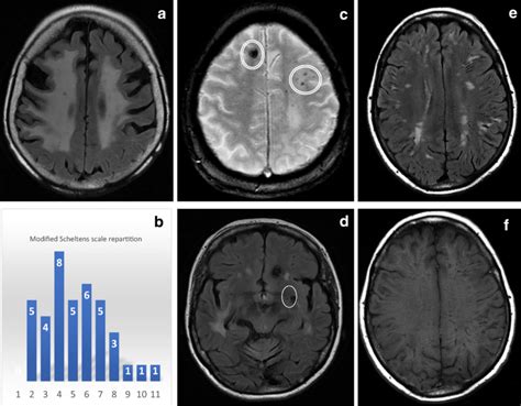 Leukopathy And Cerebral Small Vessel Disease Aspects A Symmetrical