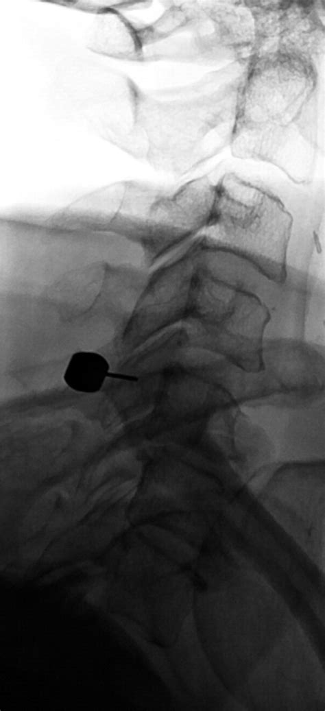 Treatment Of Facet And Sacroiliac Joint Arthropathy Steroid Injections