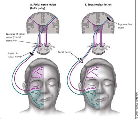 Among these findings was that lesion of the seventh cranial nerve. Bell's Palsy: Diagnosis and Management - American Family ...