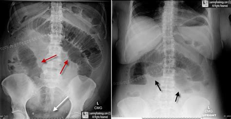 Learning Radiology Small Bowel Obstruction Sbo