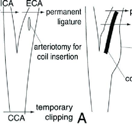 Diagrams Illustrating The Exposure Of The Common Carotid Artery CCA