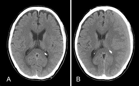 Figure1brain Ct Scan A A Ct Image At The Time Of Initial Head Trauma