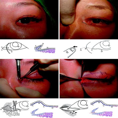 Medial Epicanthoplasty Using The Skin Redraping Method Plastic And