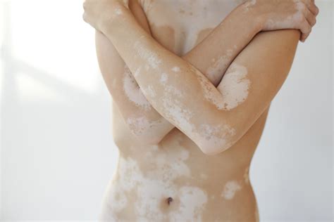 Vitiligo affects people of all skin types, but it vitiligo. Vitiligo - Dr. Hönle Medizintechnik