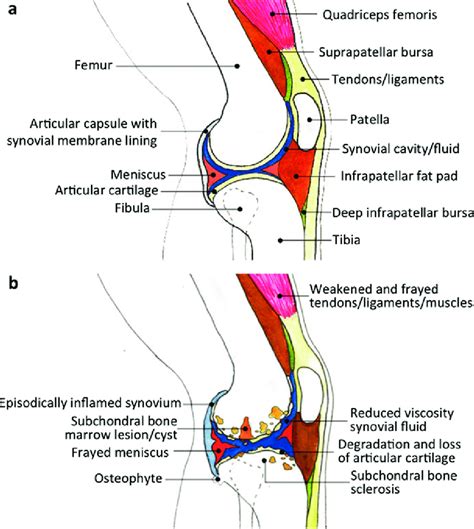 Diagrammatic Overview Of Osteoarthritis Pathology Sagittal View Of The