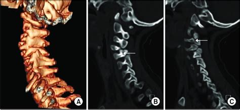 Three Dimensional Computed Tomography 3d Ct Of Cervical Spine A