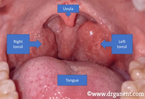 Tonsil Stone Removal