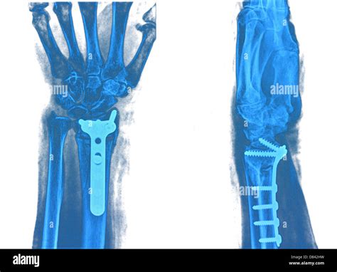 Hand Xray Hi Res Stock Photography And Images Alamy