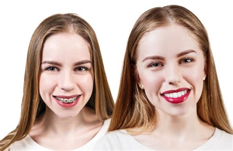 Teeth Whitening Brisbane Dentist