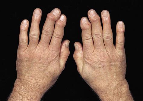 Eine arthrose der finger verläuft manchmal aber auch schmerzfrei ohne ernsthafte beeinträchtigung. Osteoarthritis (OA) - Musculoskeletal and Connective ...