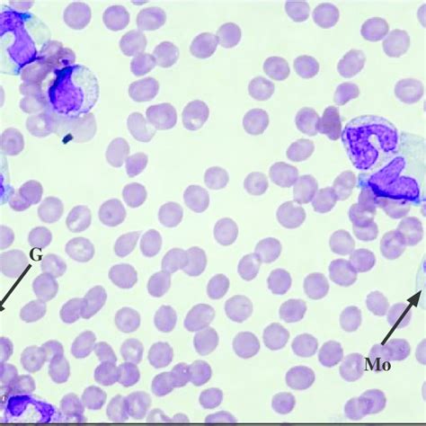 Peripheral Blood Fi Lm Of Patient 2 Showing Immature Granulocytes G