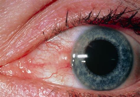 Pinguecula And Pterygium Eye Disorders Merck Manuals Consumer Version