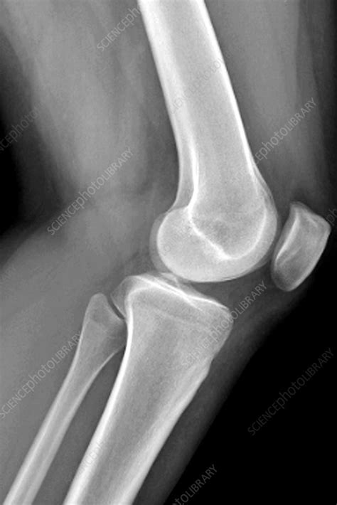 Healthy Knee Joint X Ray Stock Image C0096753 Science Photo Library