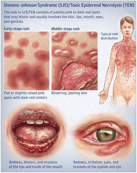 Stevens Johnson Syndrome And Toxic Epidermal Necrolysis JAMA Dermatol
