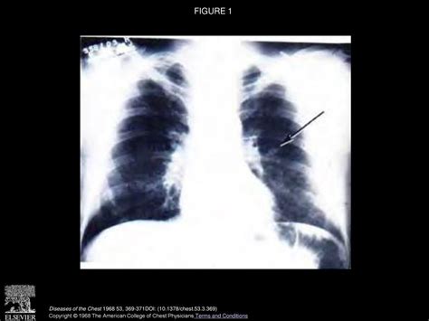 Coin Lesions Of The Lung Due To Dirofilaria Immitis Ppt Download