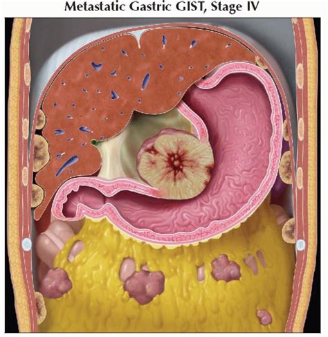 Gastrointestinal Stromal Tumor Gist Radiology Key