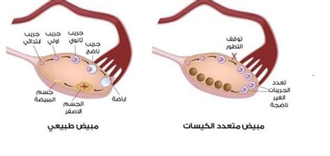 هل الكيس الدهني على المبيض خطير