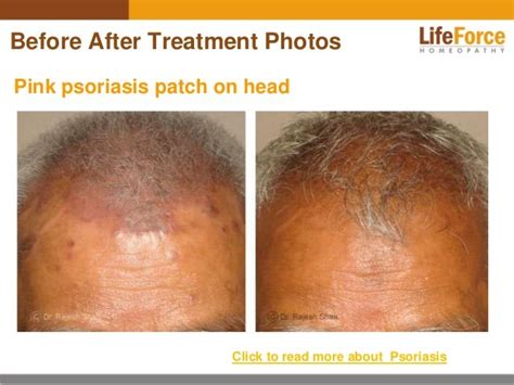 Psoriasis On Scalp And Head Photos Before After Treatment Pictures