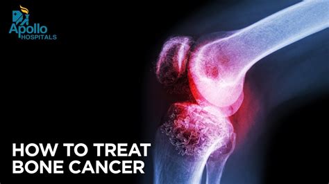 Identifying And Managing Cancer Of The Bone Early Signs Of Bone Cancer