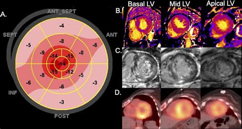 Multimodality Imaging For The Diagnosis Of Infiltrative
