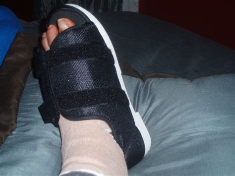 After My Foot Bunion Surgery Hubpages