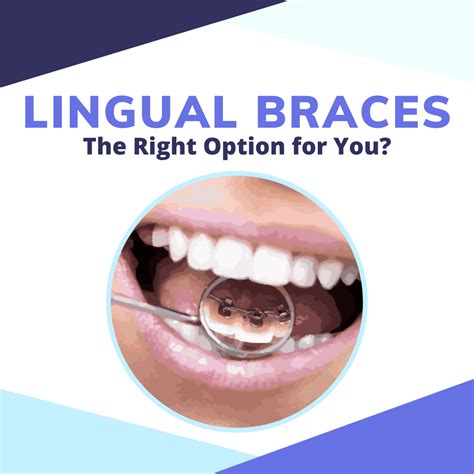 Lingual Braces The Right Option For Your Teeth Smile Prep