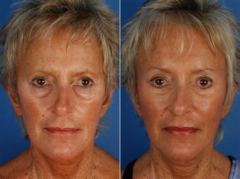 Blepharoplasty Photos Naples Fl Patient 10916