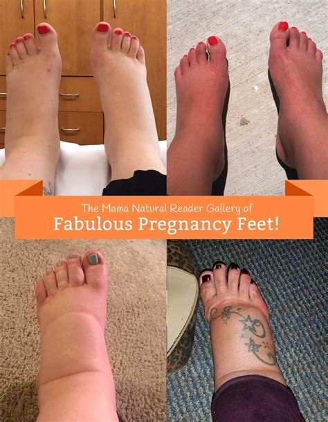Swollen Feet After Delivery Symptoms Veins Newsletter Sales Of Photos